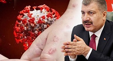Bakan Koca açıkladı... Türkiye'de ilk maymun çiçeği vakası görüldü!