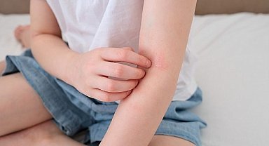 Çocuklarda 'Alerjik Hastalıklar' Hakkında Doğru Sanılan 8 Hatalı Bilgi!